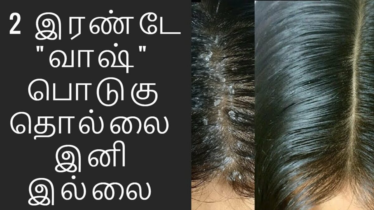 home-remedies-for-dandruff