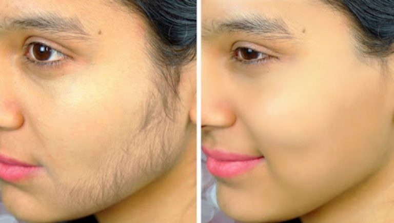 Tips to remove Hair in Face