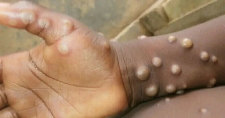 Monkey measles threatening the world! The report published by the World Health Organization!