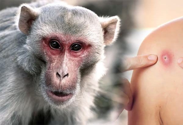 For the first time in this country, a person is infected with monkey measles!..People are in shock..