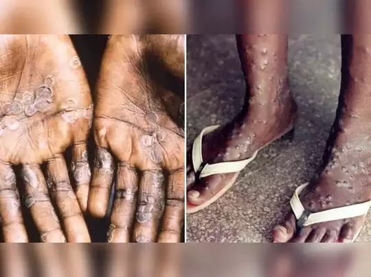 People beware! A teenager in this area has symptoms of monkeypox!