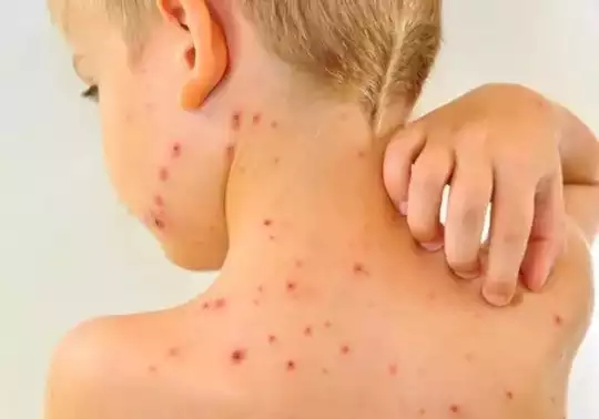 People beware! A new outbreak of measles!