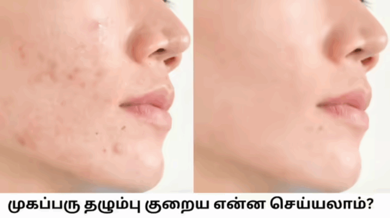 முகப்பரு தொந்தரவா? பருக்கள் தழும்பை மறைக்க இப்படி ஒரு வழியா! 