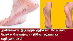 Do you have foot ulcers? Use a sugar cane saw!!