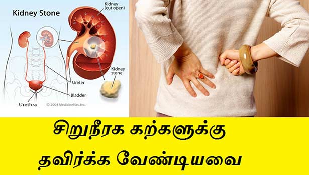 சிறுநீரகக் கல் பிரச்சனைக்கு நிரந்தர தீர்வு!!