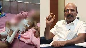 Case of child's hand removed due to wrong handshake!! The minister formed a committee to investigate !!