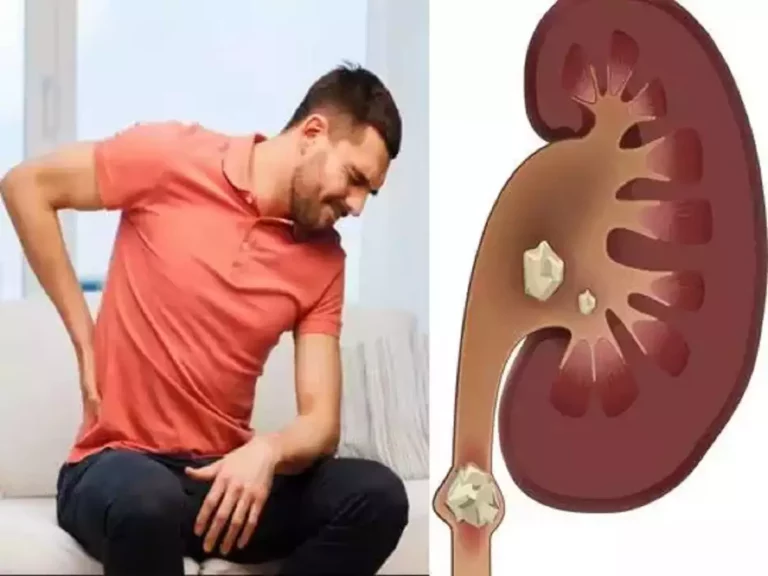 Dissolve kidney stones without spending a penny!! Just follow this!!