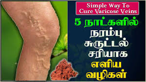 This 1 thing outside the house is enough.. Varicose vein can be fixed in 5 days!!