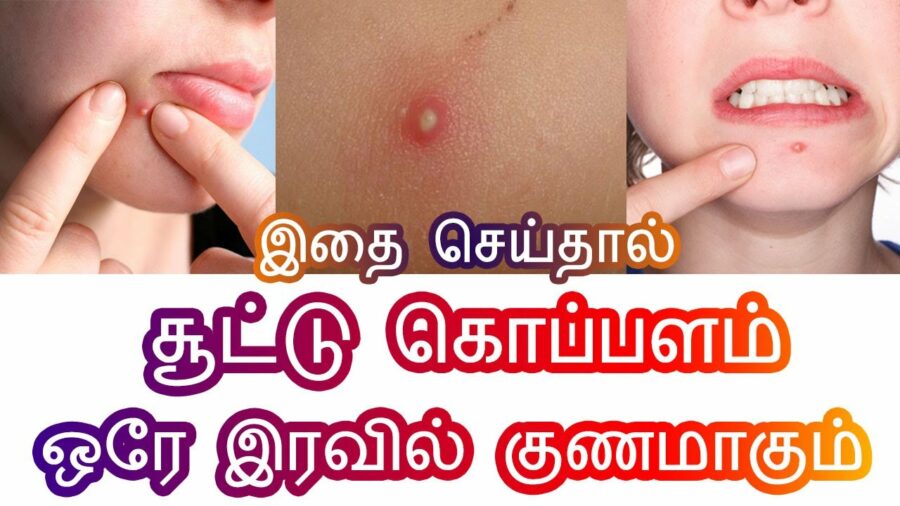ஒரே இரவில் சூட்டு கொப்பளம் கரைய இதை மட்டும் தடவுங்கள்!