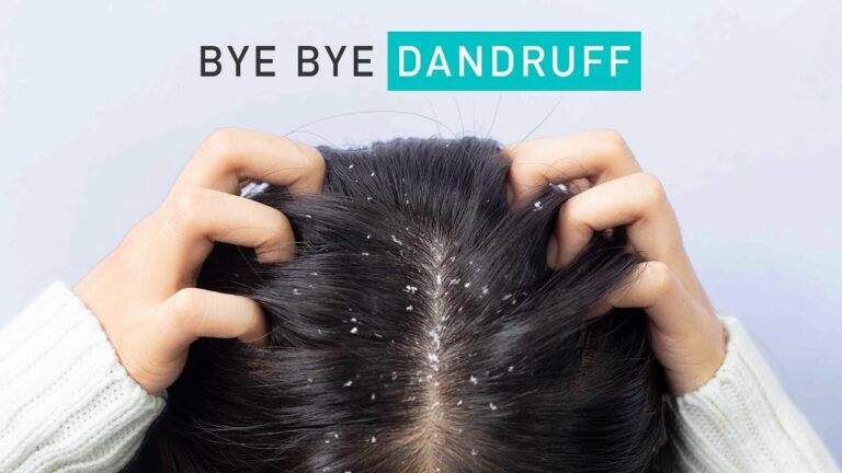 Apply this oil to your scalp and get rid of dandruff forever!!