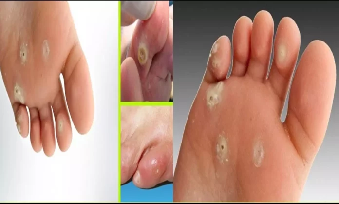 Ingrown toenails? Herbal medicine to cure this in one day!!