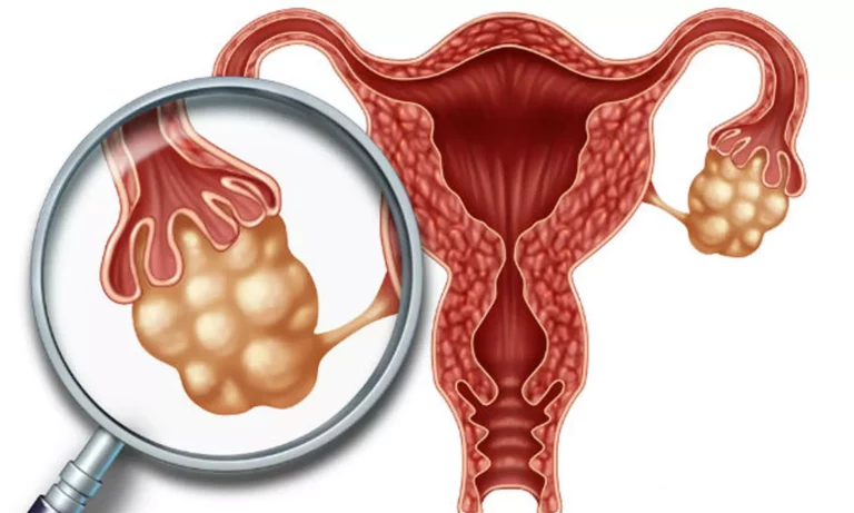Uterine cyst? 10 Herbal Remedies To Dissolve It Without Surgery!!