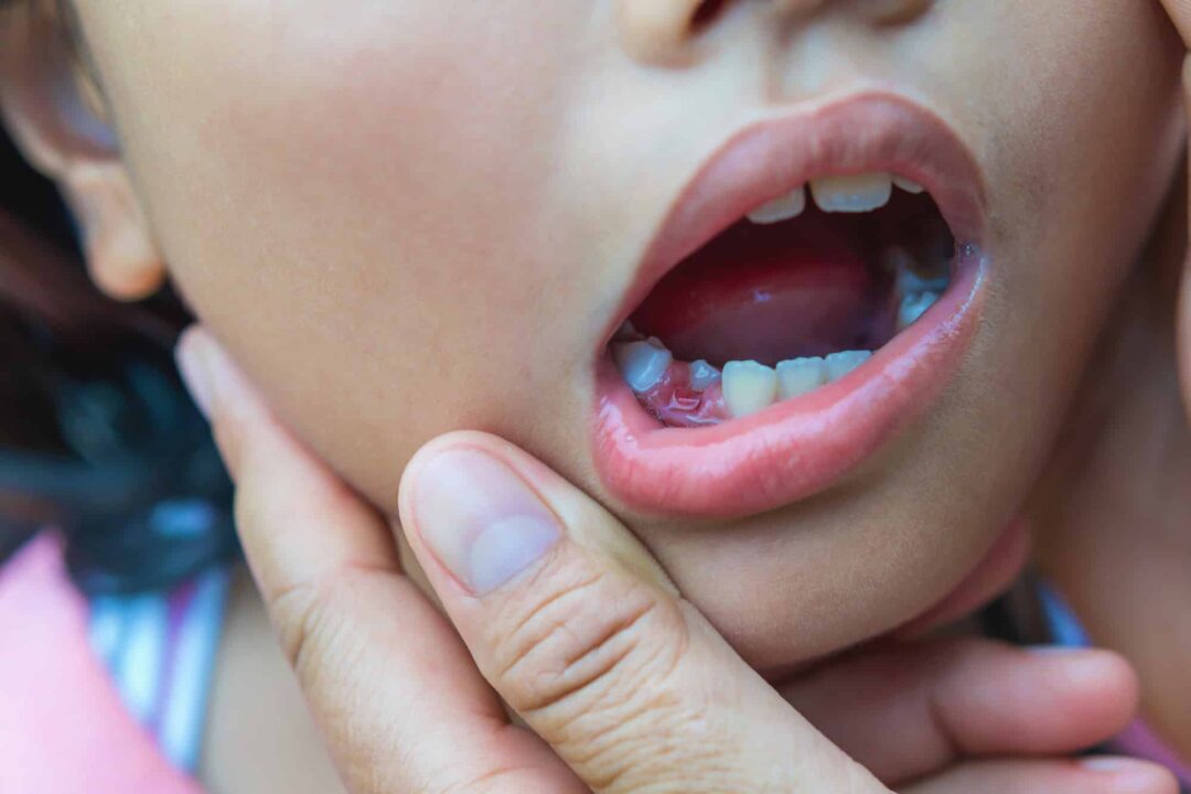 Are the teeth that fell out and erupted again? This can be fixed in a very easy way!!