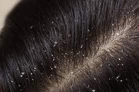 Follow these home remedies to get rid of dandruff without spending a penny!!
