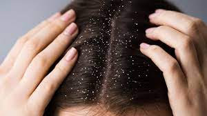 Suffering from never-ending dandruff? Grind it and apply it for a permanent solution!!