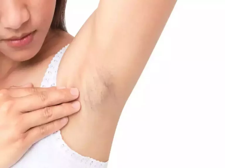 Do you often get lumps in your armpits? It is a cancerous tumor and get checked here!!