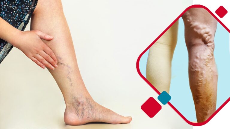 Varicose Veins: Remedies for Varicose Veins are now available!!