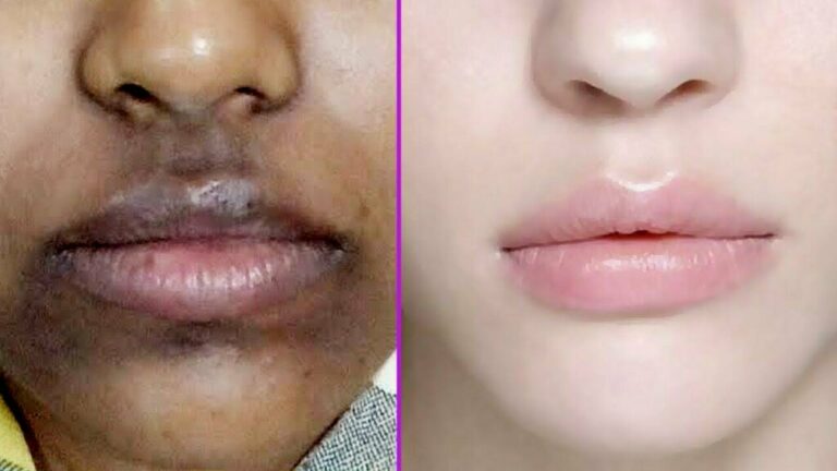 Black Pigmentation on Mouth