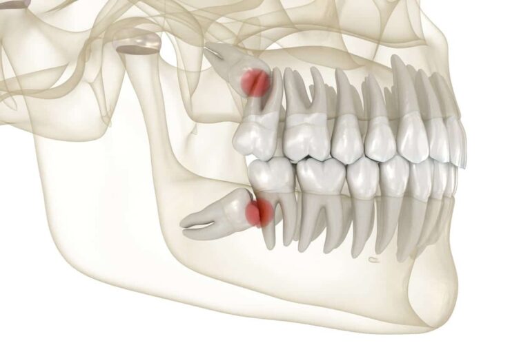 The pain caused by the knocking wisdom tooth.