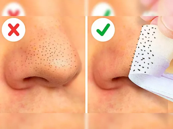 Is the blackhead on the nose detracting from beauty? Apply homemade cream to remove it easily!