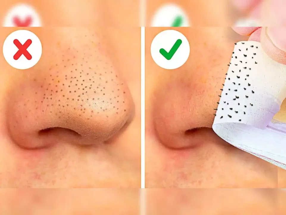 Is the blackhead on the nose detracting from beauty? Apply homemade cream to remove it easily!