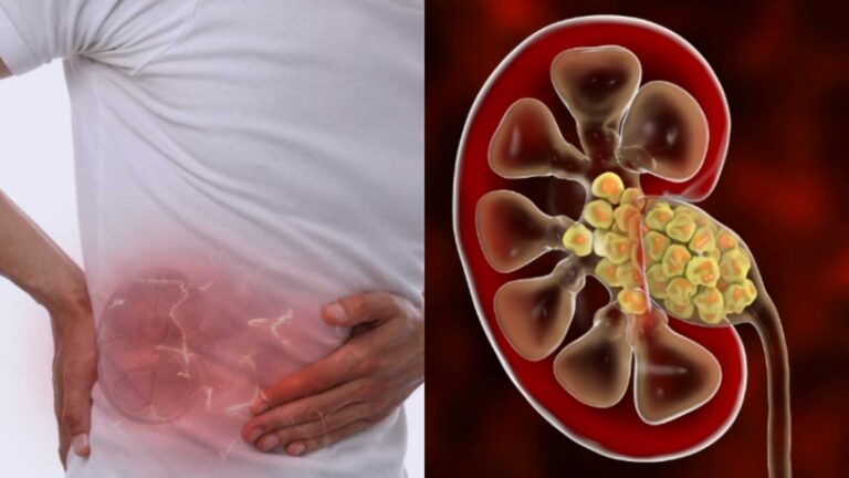 Want to dissolve kidney stones for ale without spending a penny? Then do it for a month!!