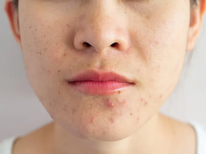 Want to get rid of acne on your face? Just these two ingredients are enough!