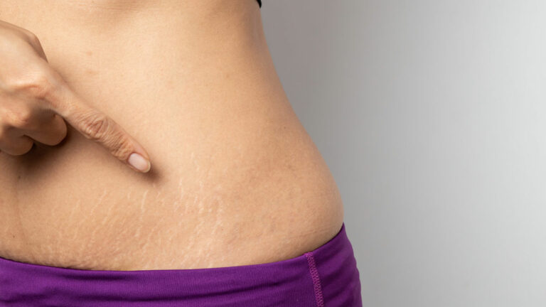 Want to hide stretch marks on your body? Here are some handy tips!