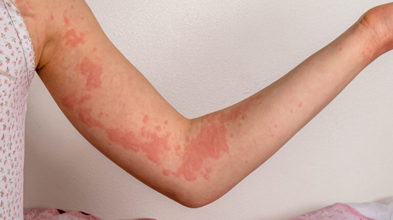 Do you want the allergy in the body to disappear quickly?