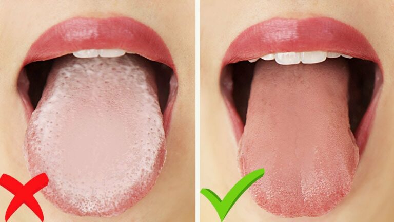 Does your tongue have a WHITE LAYER even after using TUNCK CLEANER? These tips will help you remove it easily!!