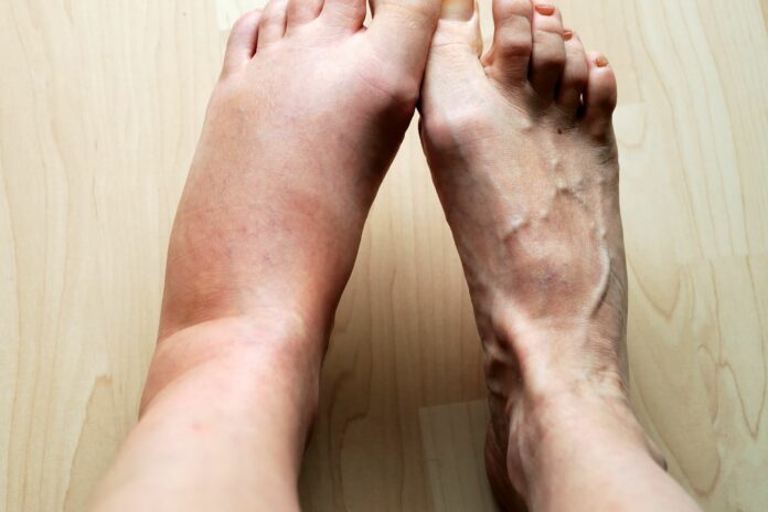 Are ankles often swollen? Try these best tips to fix it!!