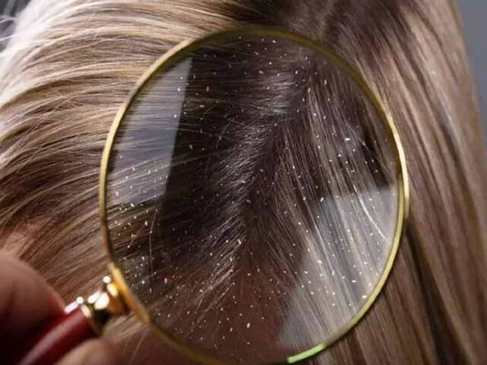 Do you have dandruff on your head? Then just do this right away!