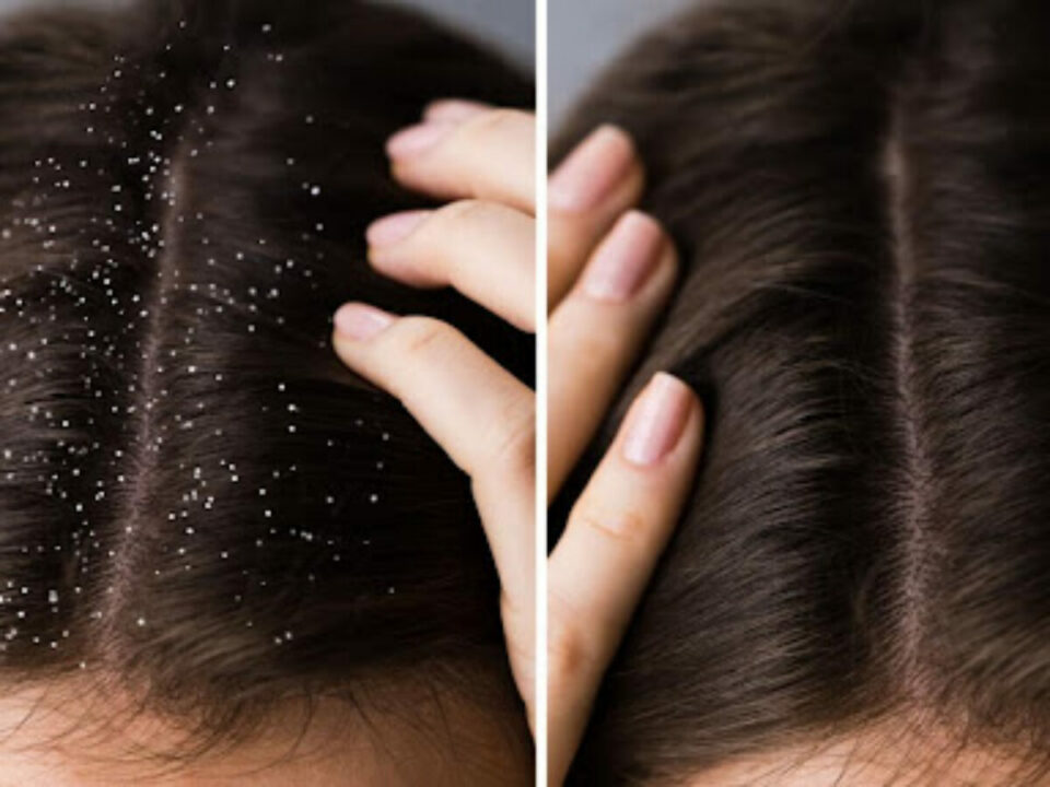 Dandruff Problem? Just do this to get rid of dandruff in five minutes!!