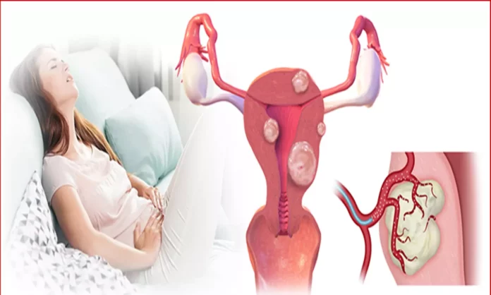 These women are likely to get uterine tumor & swelling! How to cure this easily?