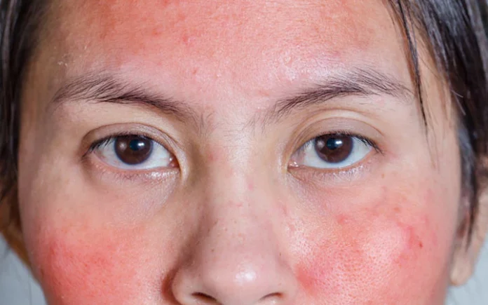 Does your face often get red and irritated? Do this.. It will be cured immediately!!