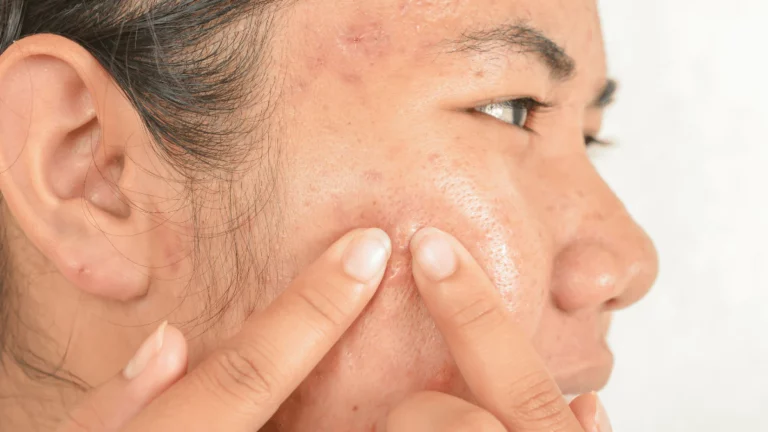 Are you getting more acne on your face? So use the egg like this!