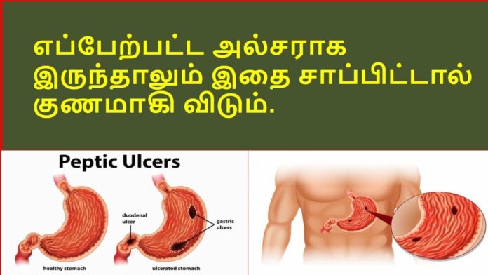ULCER: A spoonful of boiled rice can cure ulcers completely! This is empirical medicine!!