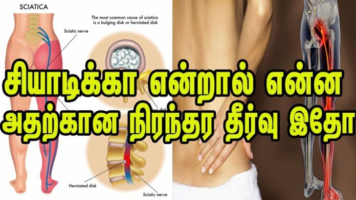 If you are suffering from sciatica problem.. Follow this to cure it immediately!!