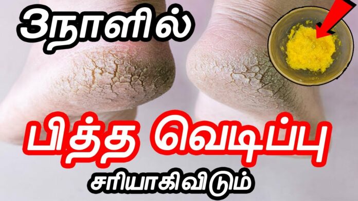 Suffering from cracked heels and pain? FOLLOW THIS IMMEDIATELY!!