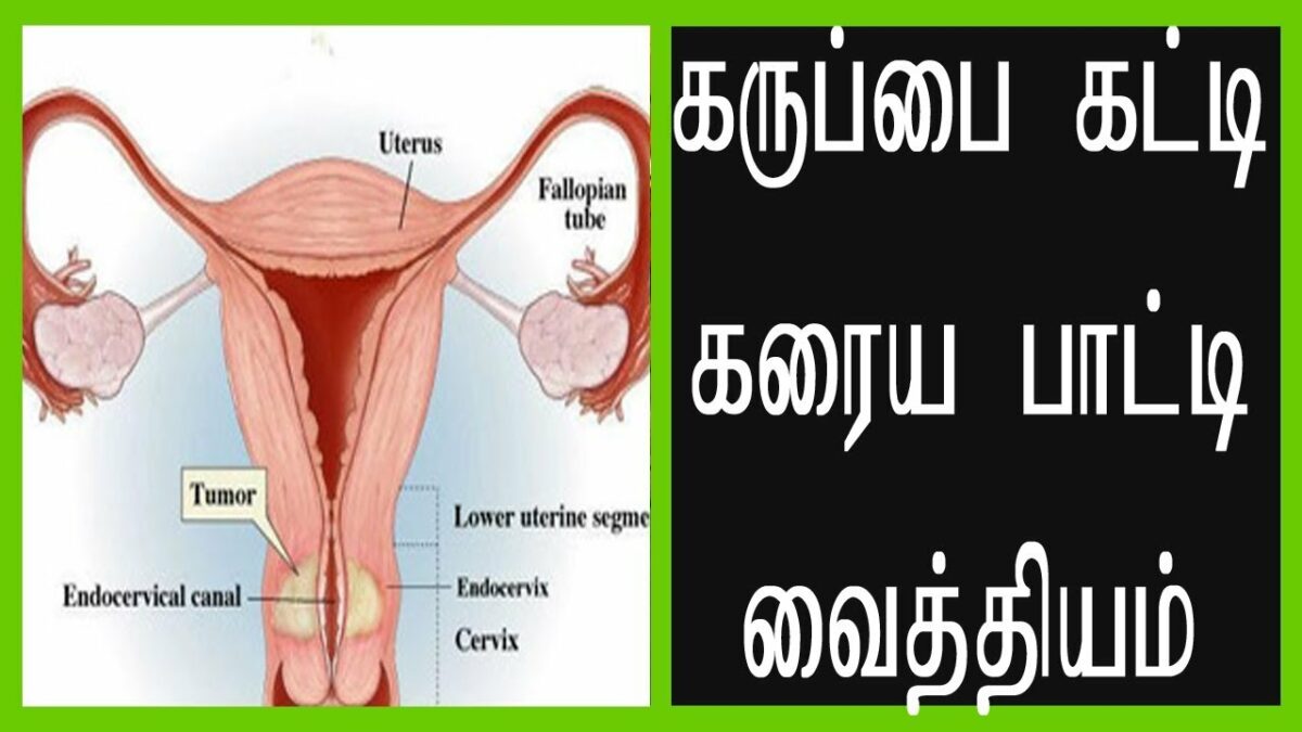 PCOS (Prostate Cyst) Problem: Just Do This Uterine Tumors Dissolve In One Month!!