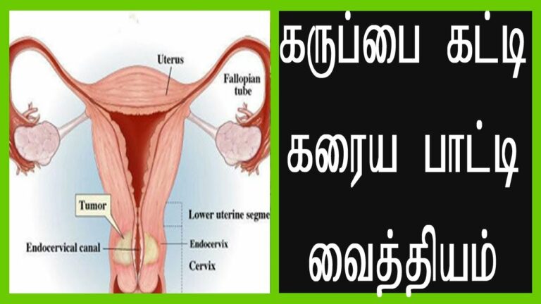 PCOS (Prostate Cyst) Problem: Just Do This Uterine Tumors Dissolve In One Month!!