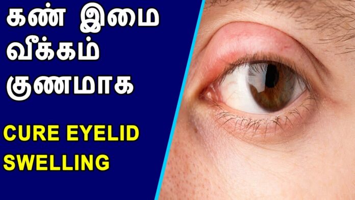 Apply 2 drops of this to cure eye swelling in 1 day!!
