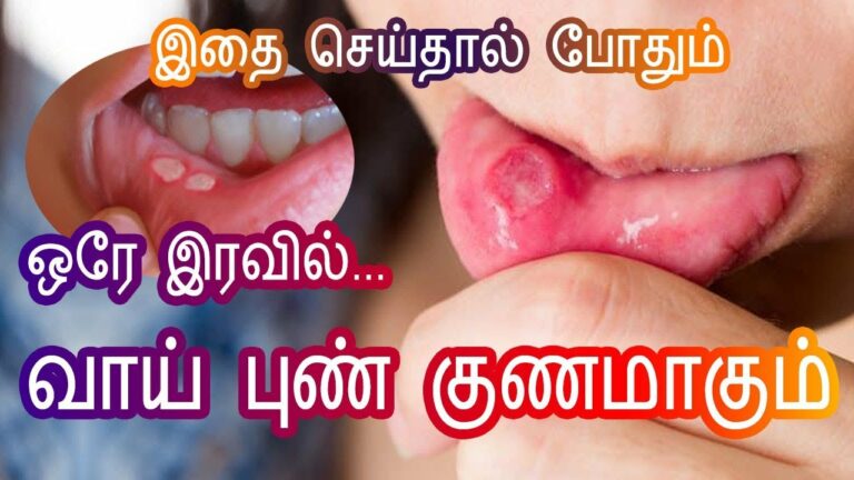 ulcer treatment in tamil