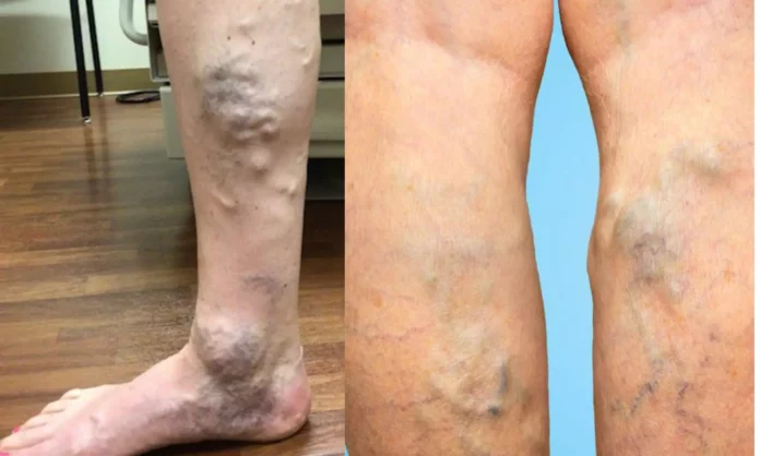 Varicose Vein: Instant Solution for Varicose Veins!! Try it now!