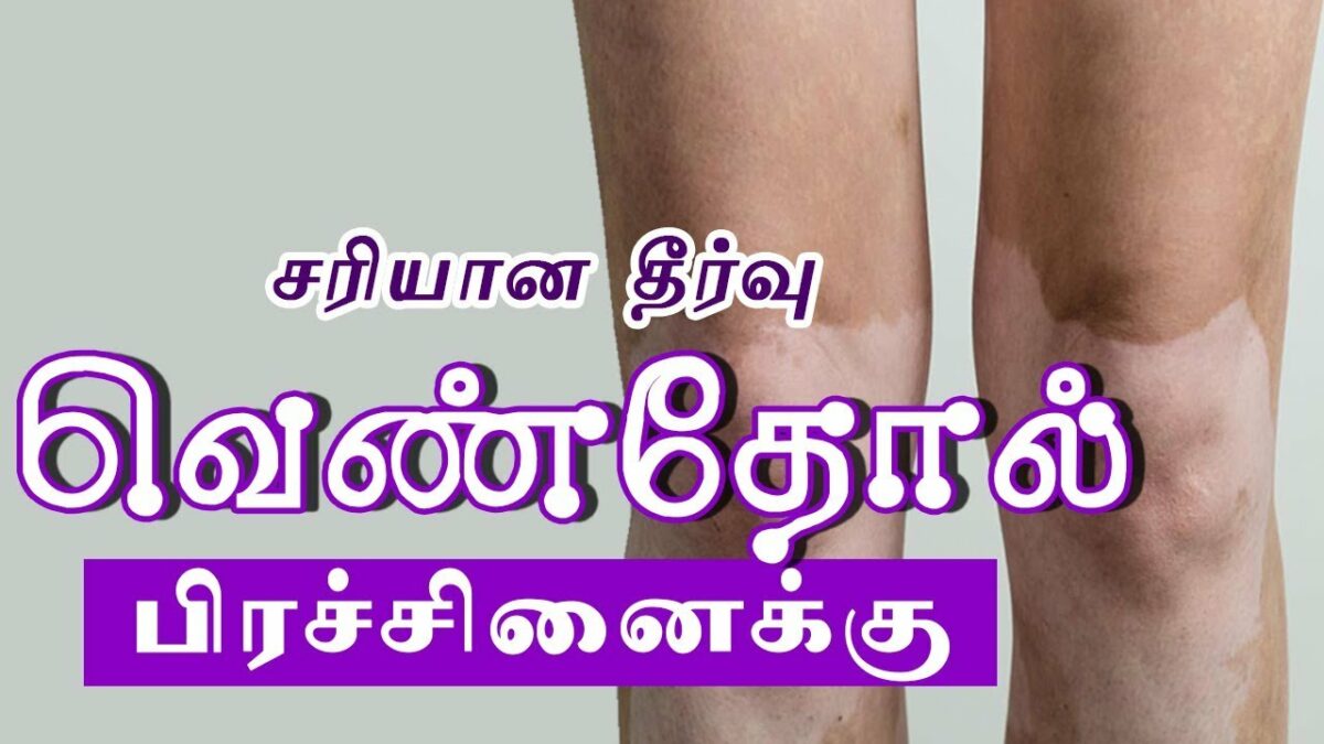 Ven Kushtam Vitiligo Treatment in