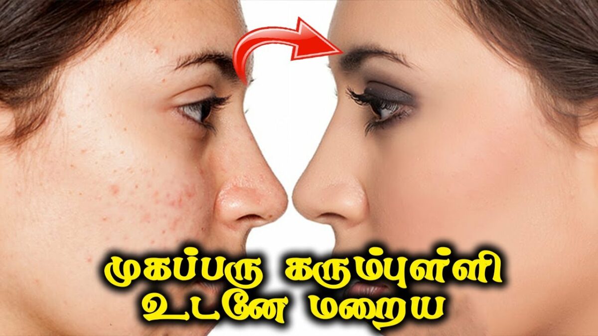 Acne black spot will disappear immediately.. use Arlikaya like this!!