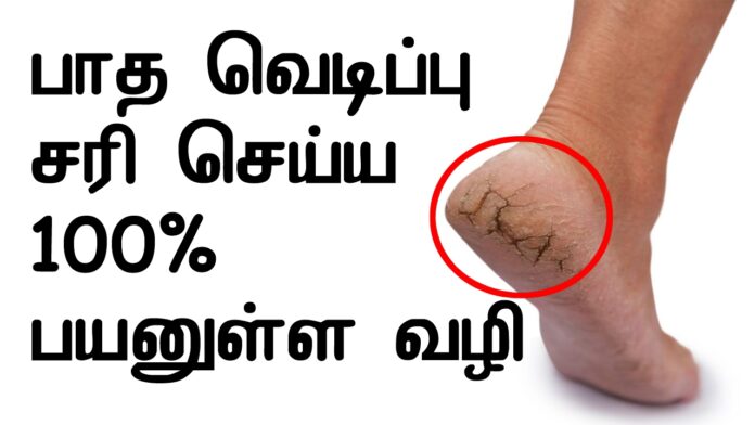 Foot eruption in 2 days is enough toothpaste at home!! Do this now!!