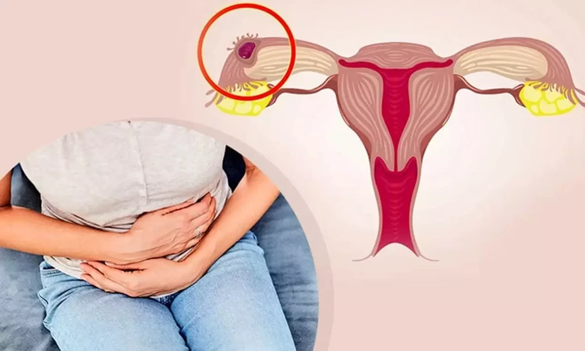 Ovarian cyst that hinders women's fertility!! There is a solution for this in greens!!