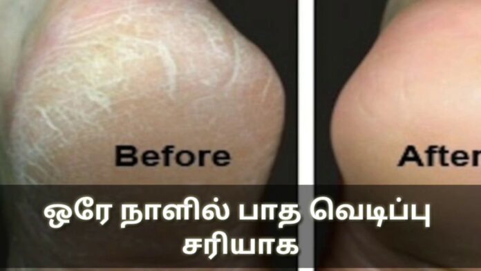 Easy treatment of cracked feet without oiling!! Try this!!