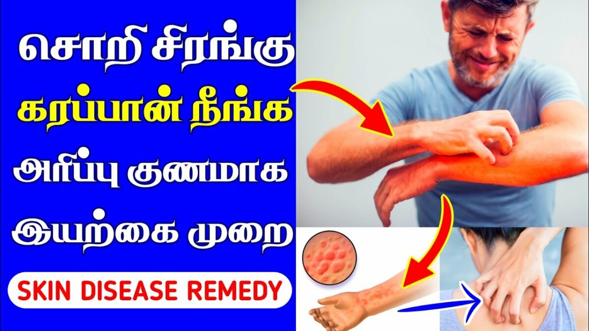 Use this home made remedy to get rid of scabies in 24 hours!!